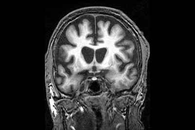 Neurodegenerative Diseases